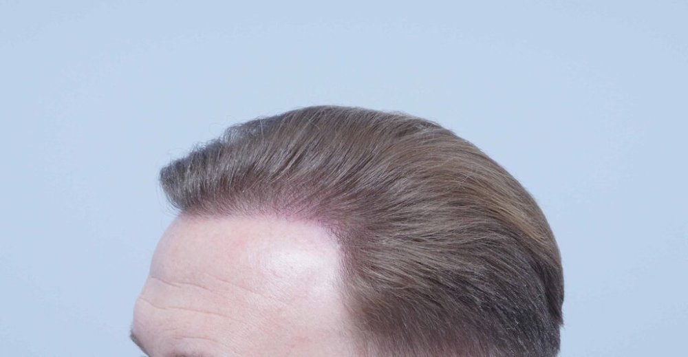 Dr. Bessam Farjo hair transplant13.jpg