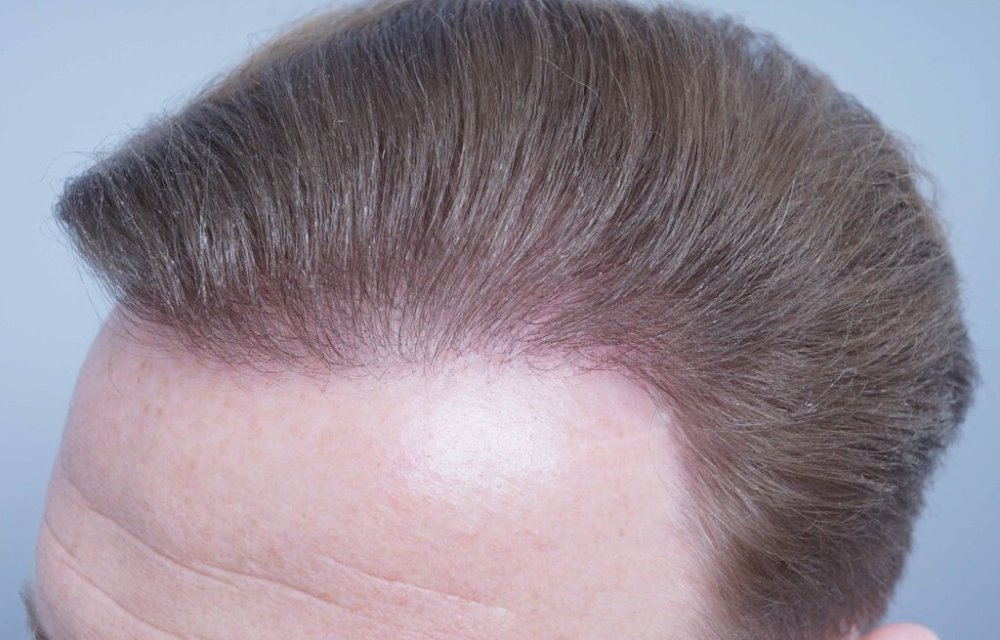 Dr. Bessam Farjo hair transplant14.jpg
