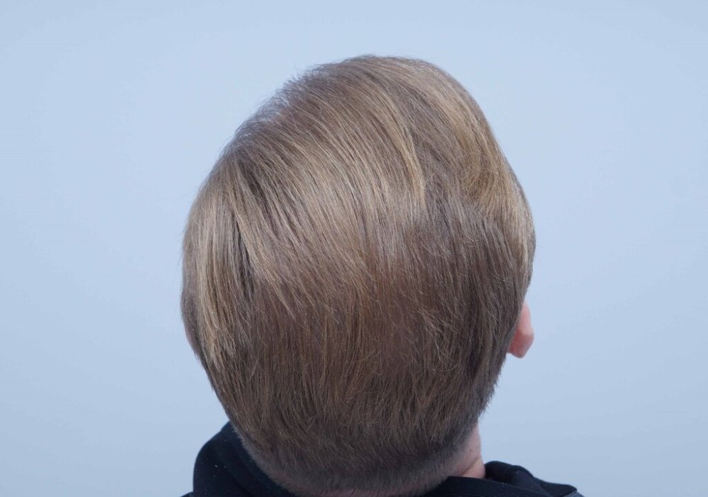 Dr. Bessam Farjo hair transplant15.jpg