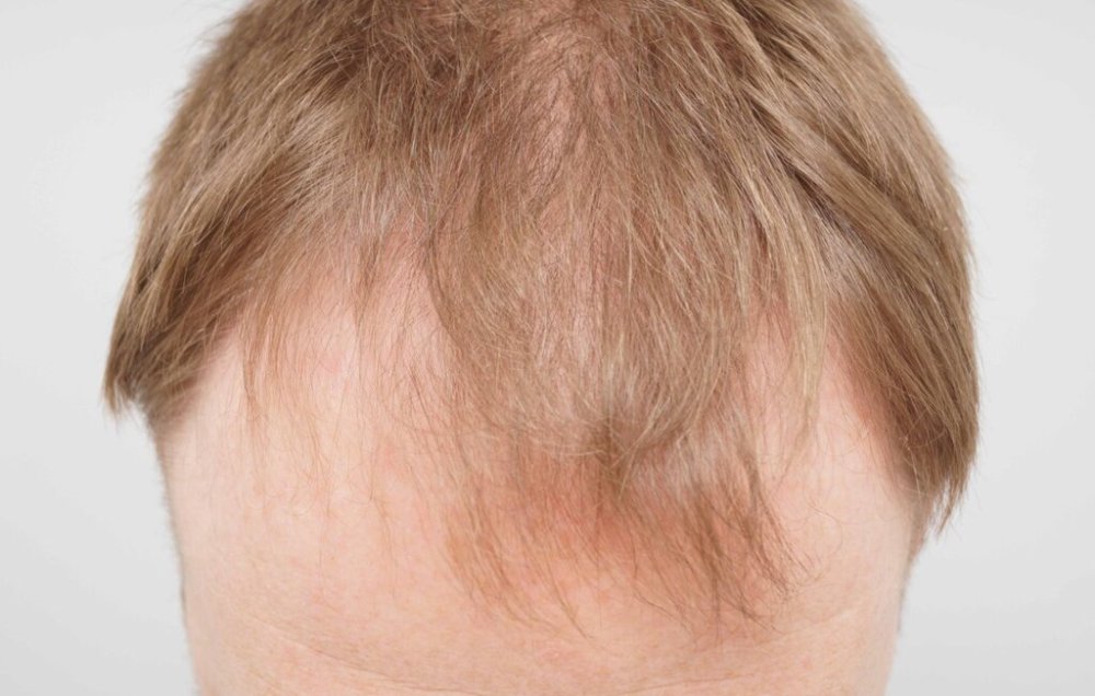 Dr. Bessam Farjo hair transplant2.jpg