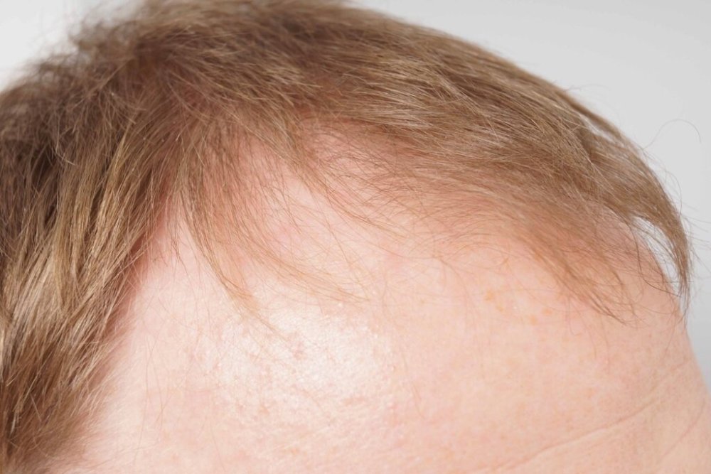 Dr. Bessam Farjo hair transplant3.jpg