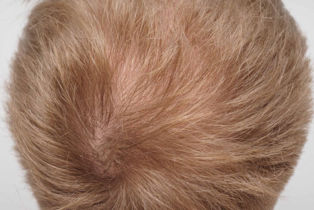 Dr. Bessam Farjo hair transplant5.jpg