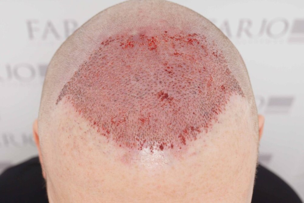 Dr. Bessam Farjo hair transplant6.jpg
