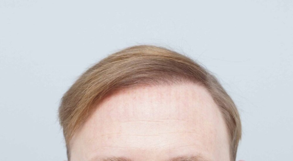 Dr. Bessam Farjo hair transplant7.jpg