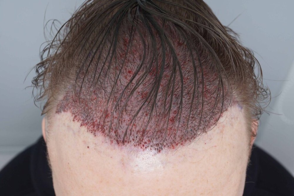 Dr. Bessam Farjo hair transplant9.jpg