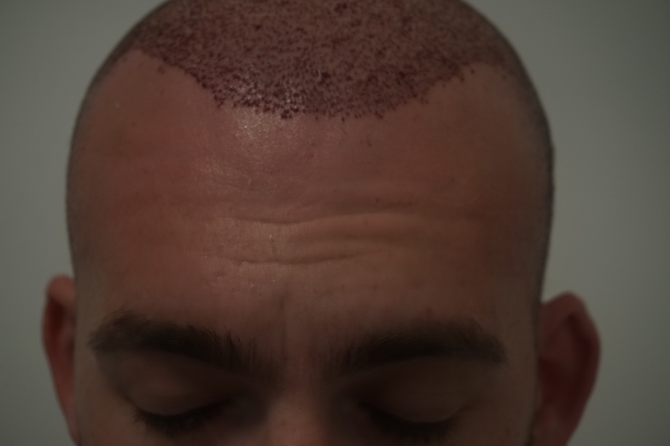 Dr Bicer Fue hair transplant Istanbul 2.png