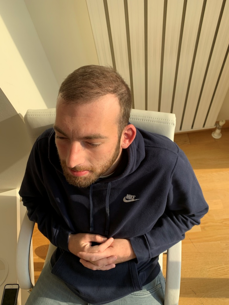 Dr Bicer Fue hair transplant Istanbul 3.png