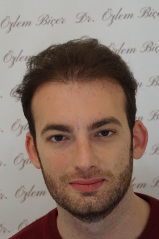 Dr Bicer Fue hair transplant Istanbul 4.png