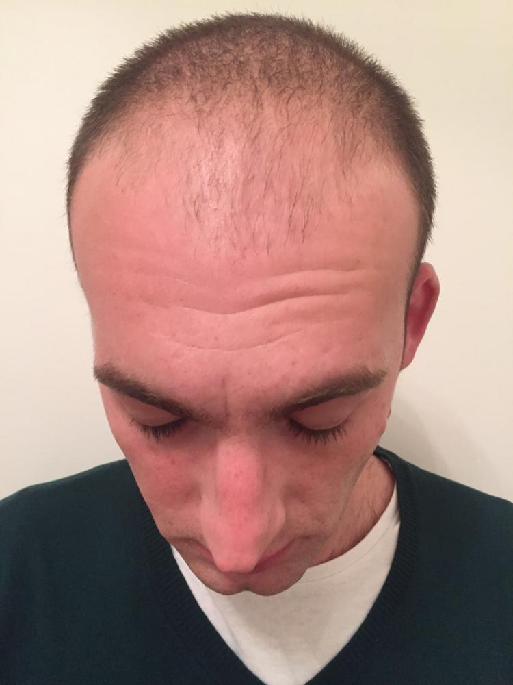 Dr Bicer Fue hair transplant Istanbul.png