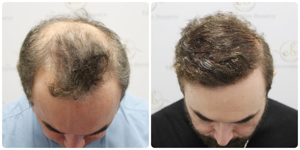 dr-bonaros-12-months-result-hair-transplant-scotland (10) (1).jpg