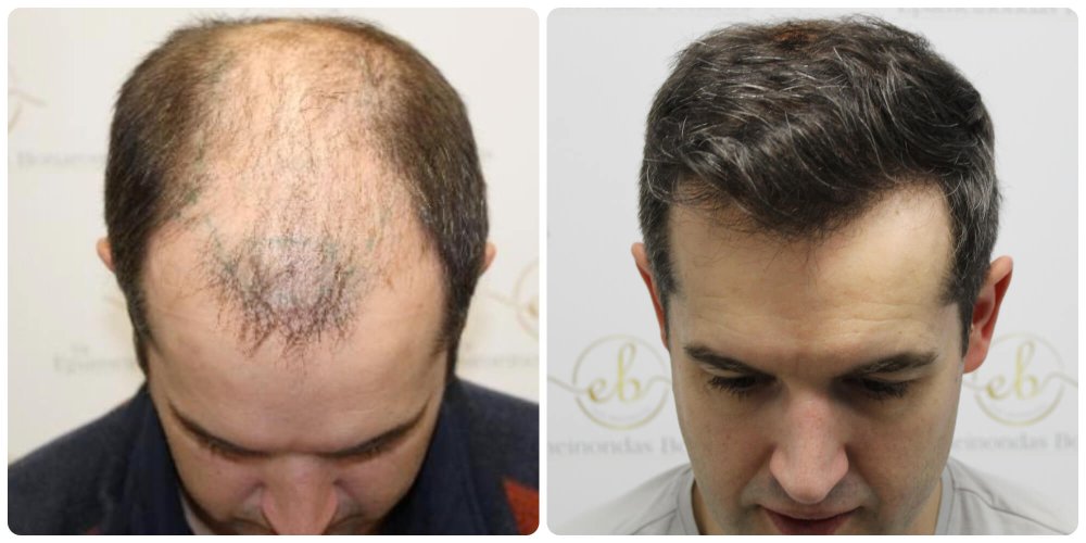 dr-bonaros-12-months-result-hair-transplant-scotland (10).jpg