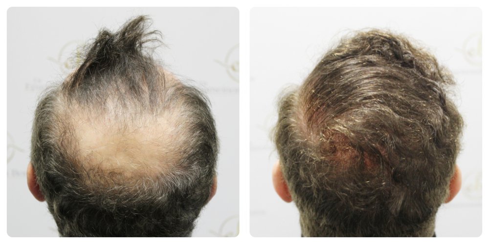 dr-bonaros-12-months-result-hair-transplant-scotland (11) (1).jpg