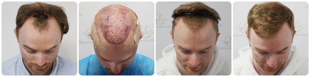dr-bonaros-12-months-result-hair-transplant-scotland (11).jpg