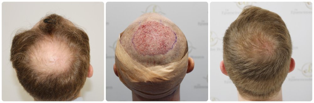 dr-bonaros-12-months-result-hair-transplant-scotland (12).jpg