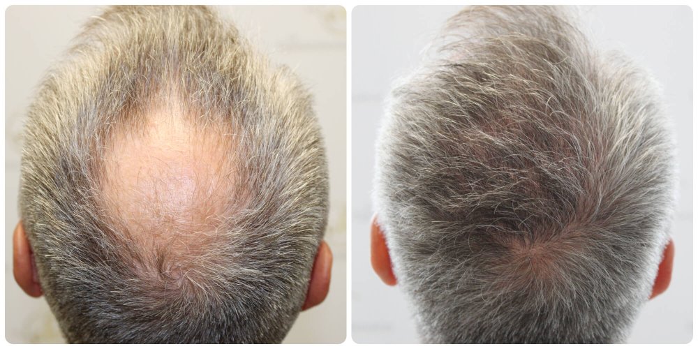 dr-bonaros-12-months-result-hair-transplant-scotland (15) (3) (1).jpg