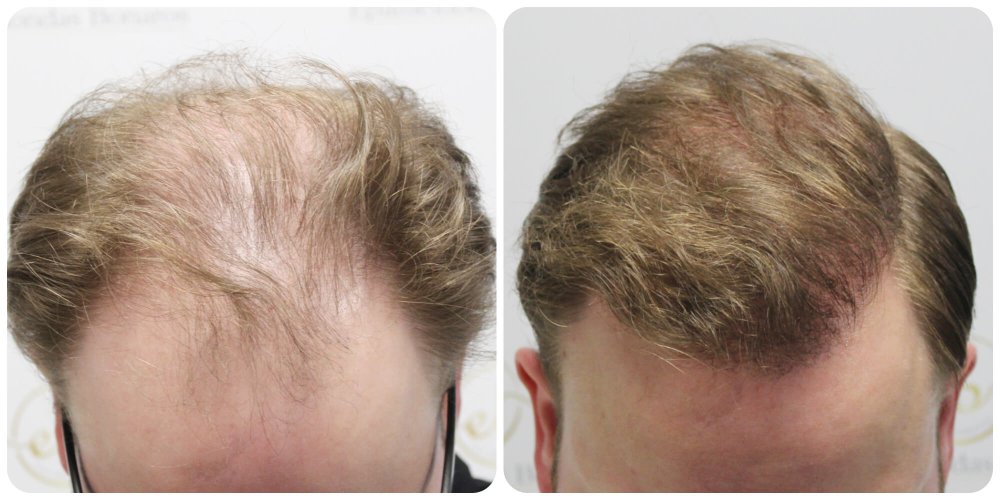 dr-bonaros-12-months-result-hair-transplant-scotland (19) (1).jpg