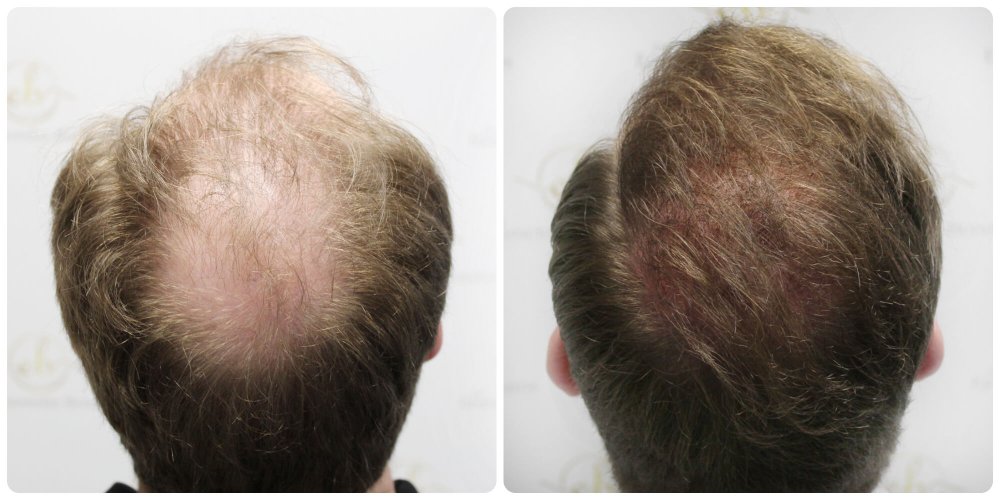 dr-bonaros-12-months-result-hair-transplant-scotland (20) (1).jpg