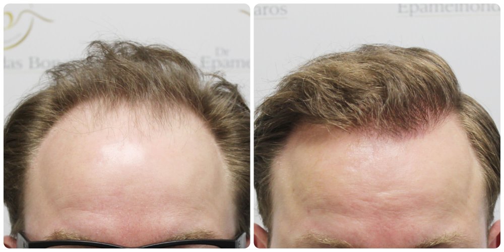 dr-bonaros-12-months-result-hair-transplant-scotland (21) (1).jpg
