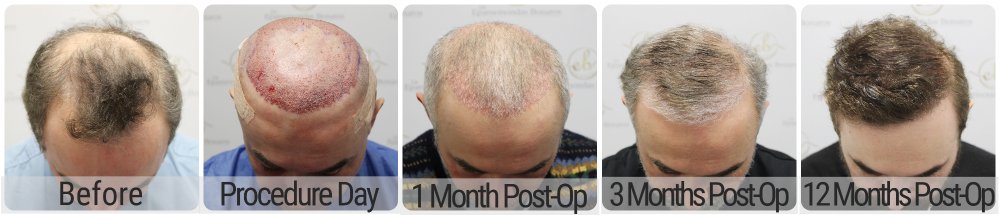 dr-bonaros-12-months-result-hair-transplant-scotland (3) (1).jpg