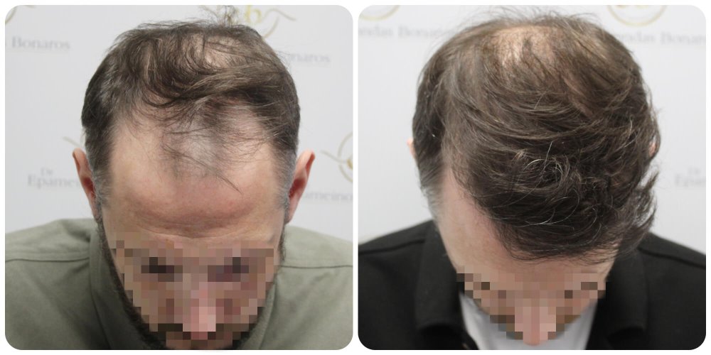 dr-bonaros-12-months-result-hair-transplant-scotland (31) (1).jpg