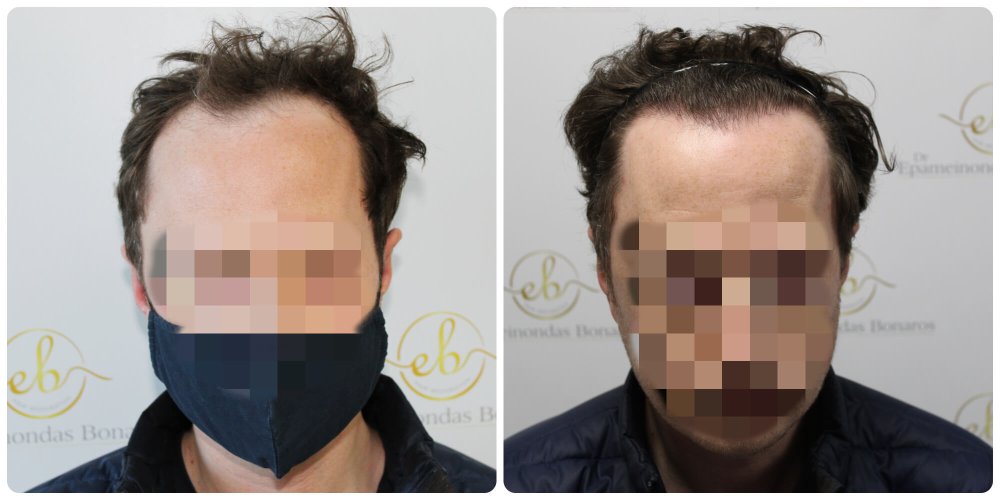 dr-bonaros-12-months-result-hair-transplant-scotland (4) (1).jpg