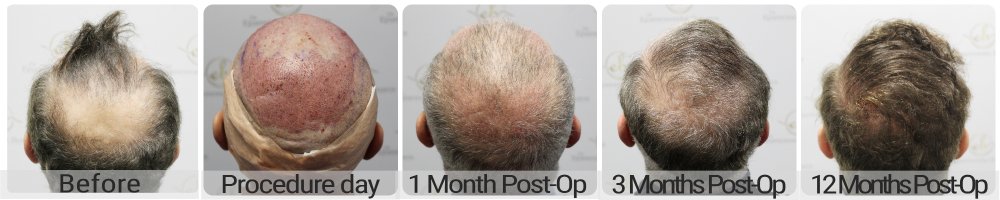 dr-bonaros-12-months-result-hair-transplant-scotland (4) (1).jpg