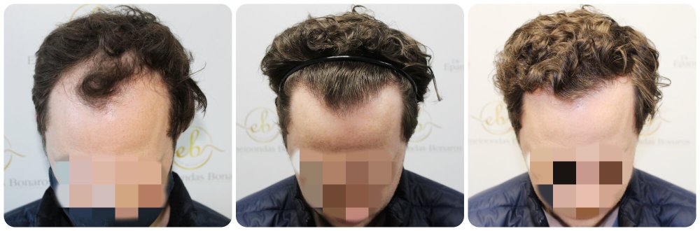 dr-bonaros-12-months-result-hair-transplant-scotland (5) (1).jpg