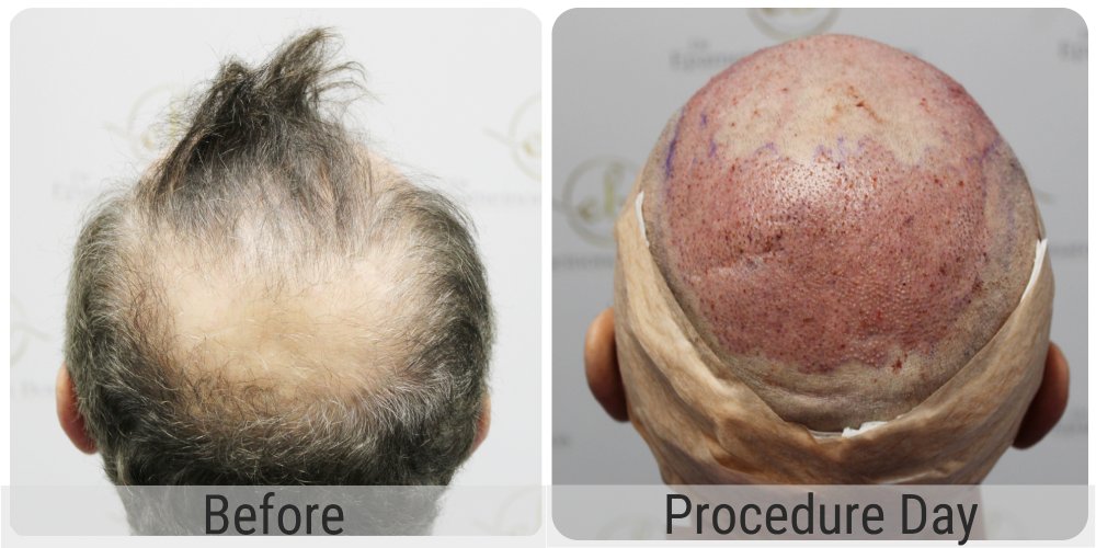 dr-bonaros-12-months-result-hair-transplant-scotland (5) (1).jpg