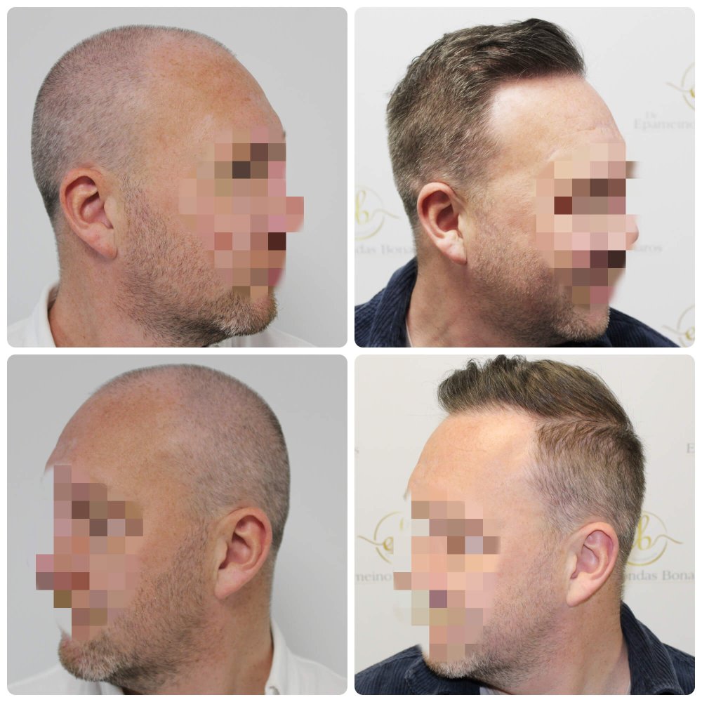dr-bonaros-12-months-result-hair-transplant-scotland (6) (1).jpg