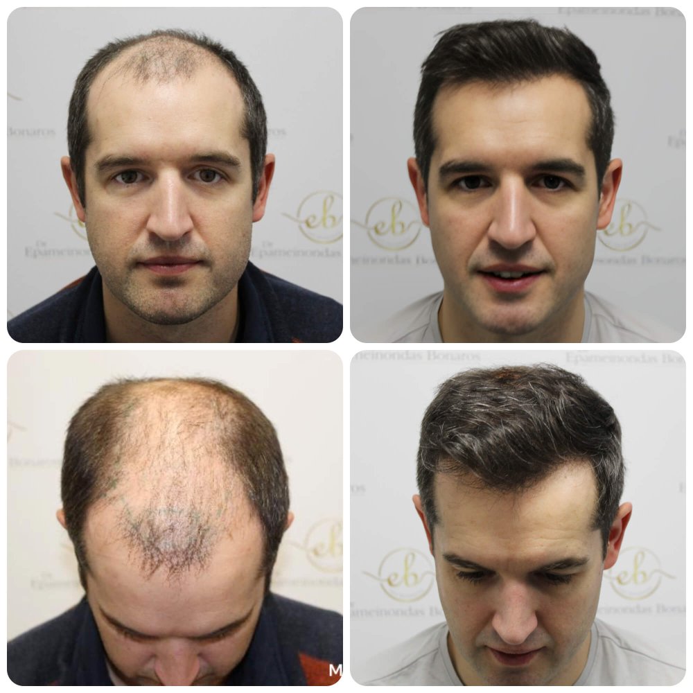 dr-bonaros-12-months-result-hair-transplant-scotland (7).jpg