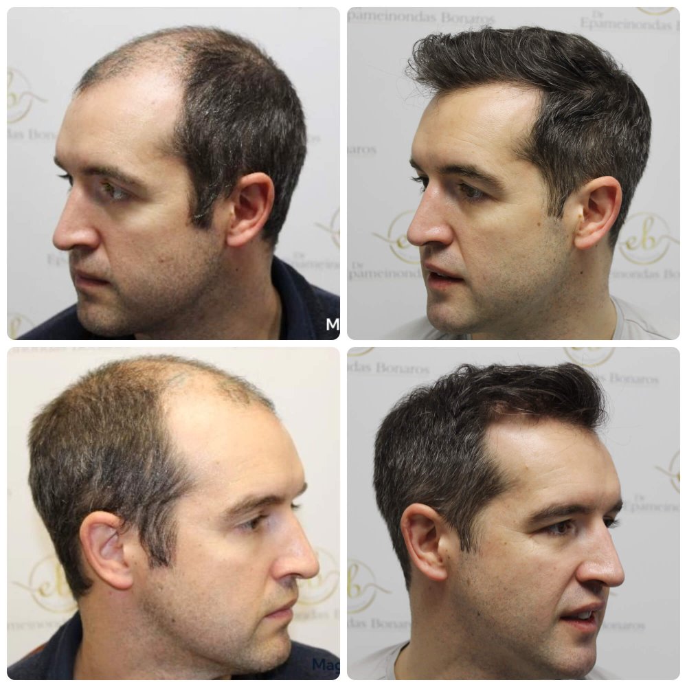 dr-bonaros-12-months-result-hair-transplant-scotland (8).jpg