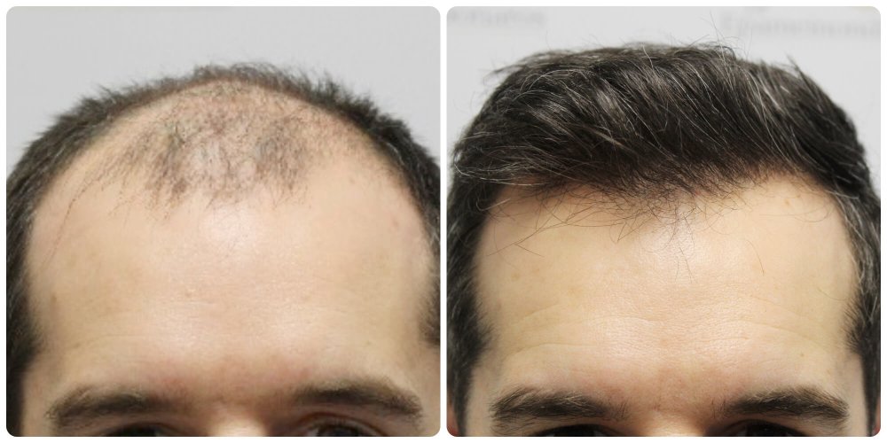 dr-bonaros-12-months-result-hair-transplant-scotland (9).jpg