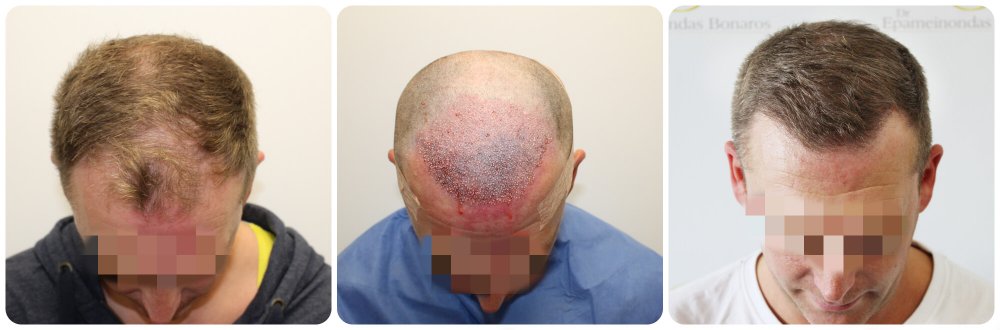 dr-bonaros-glasgow-fue-receding-hairline-treatment.jpg