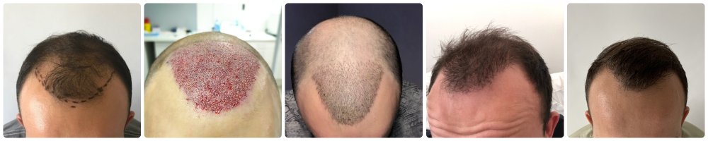 dr-bonaros-glasgow-hair-transplant-result-timeline.jpg