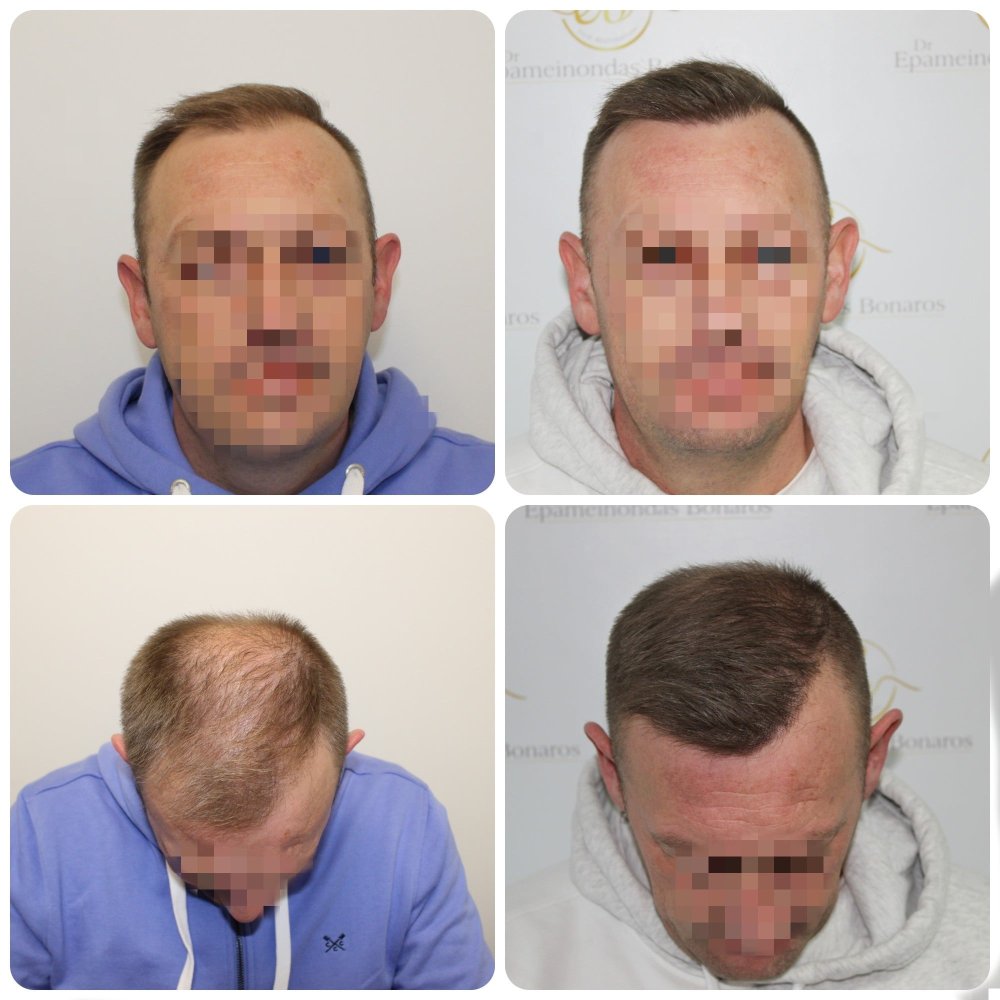 dr-bonaros-glasgow-hair-transplant-surgeon-fue.jpg