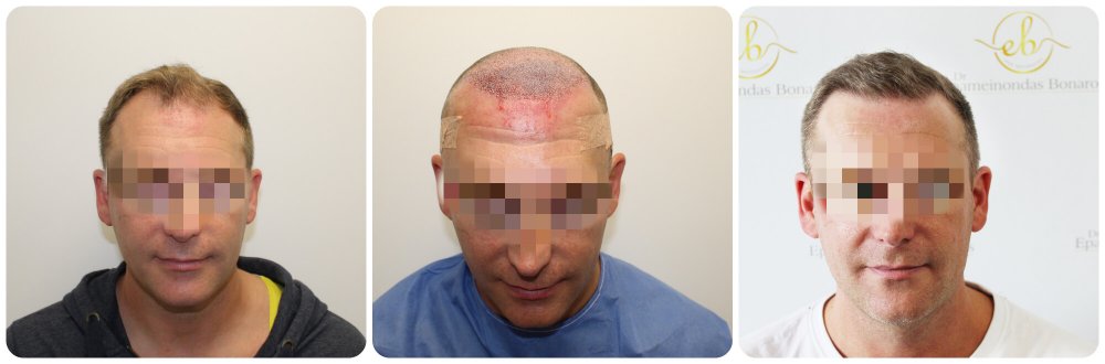 dr-bonaros-hair-transpant-before-after-photos-glasgow.jpg