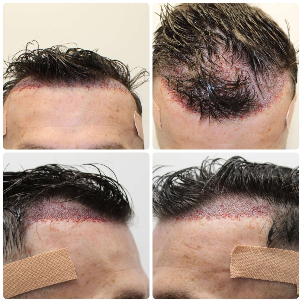 dr-bonaros-hair-transplant-glasgow.jpg