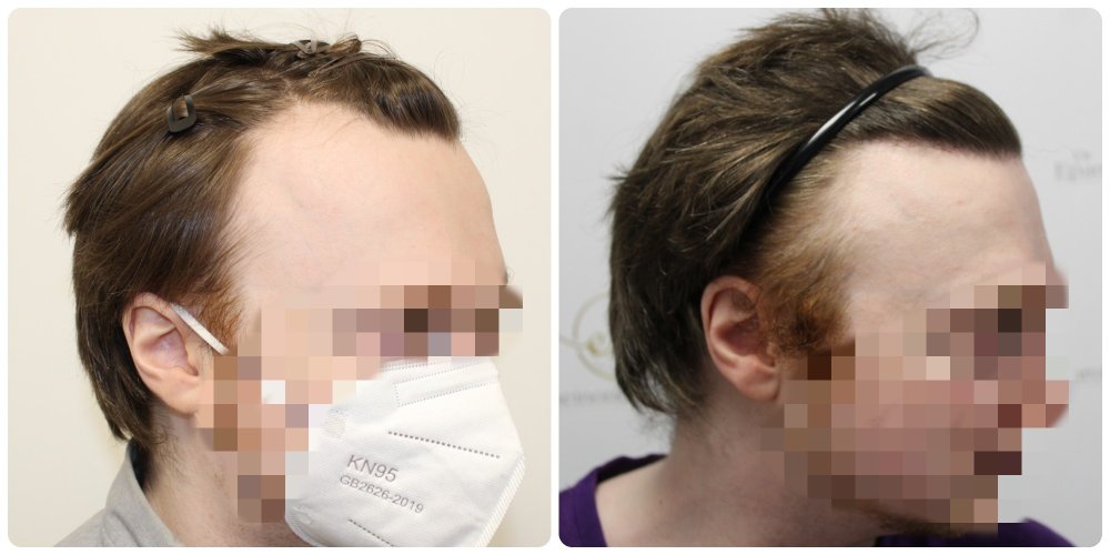 dr-bonaros-hair-transplant-glasgow.jpg