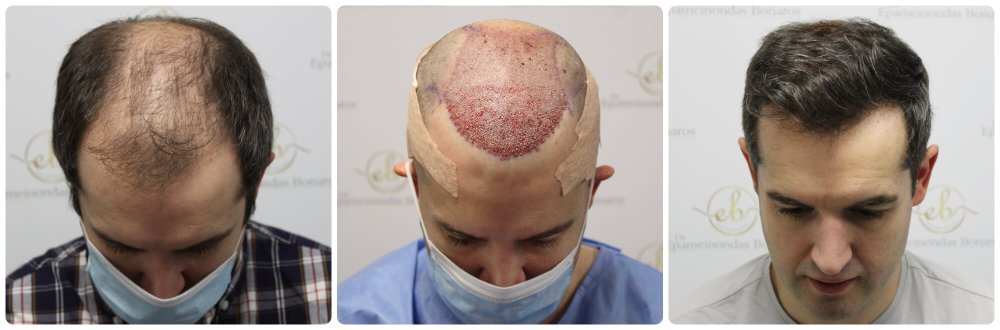 dr-bonaros-hair-transplant-glasgow-result (1).jpg