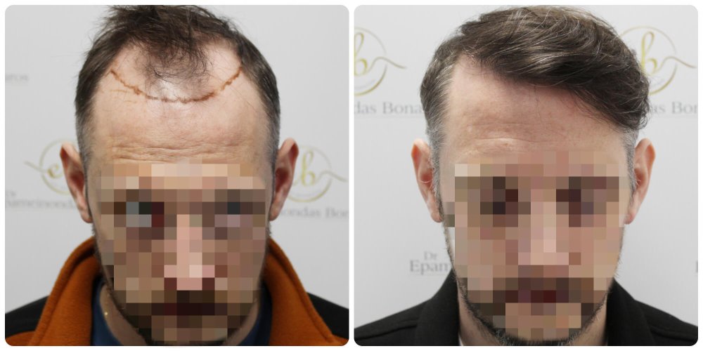 dr-bonaros-hair-transplant-glasgow-result (10) (1).jpg