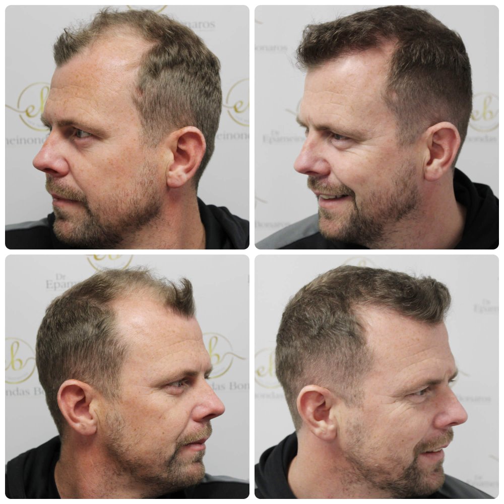 dr-bonaros-hair-transplant-glasgow-result (10).jpg