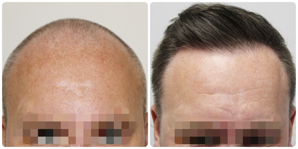 dr-bonaros-hair-transplant-glasgow-result (11) (1).jpg