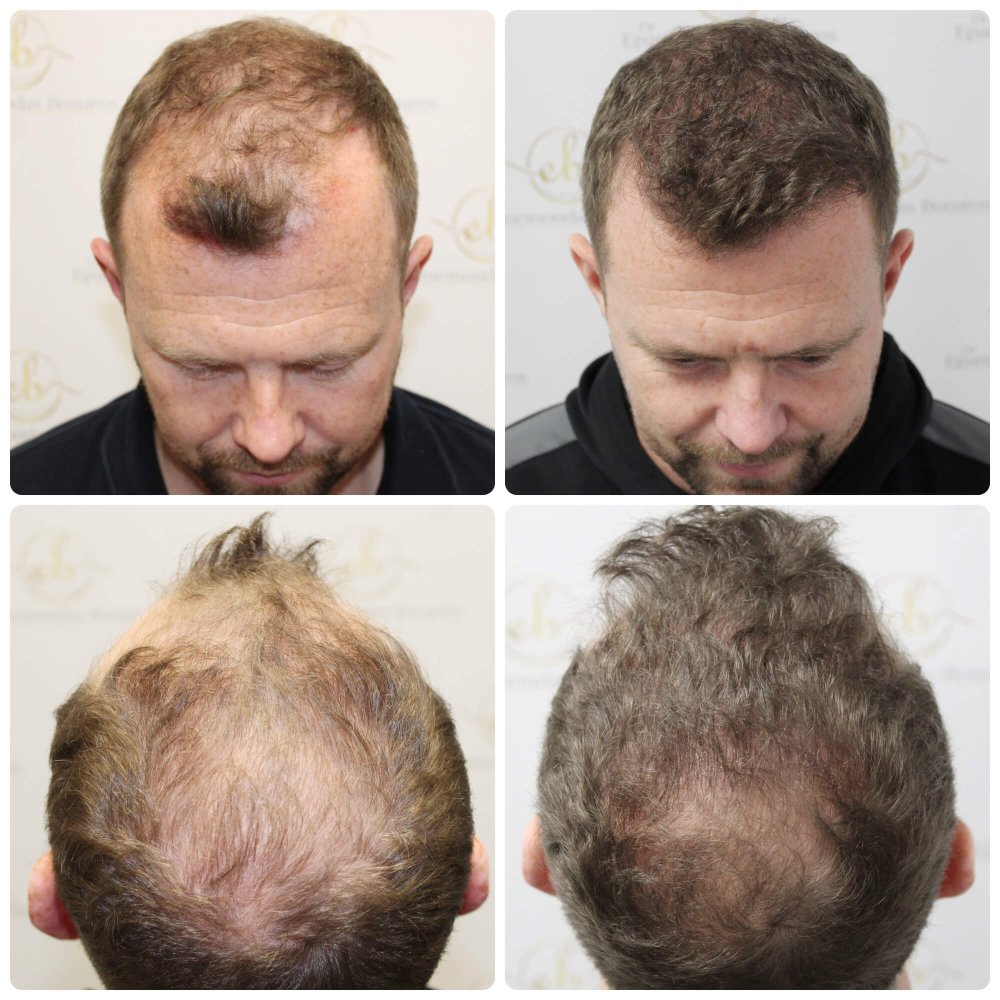 dr-bonaros-hair-transplant-glasgow-result (11).jpg
