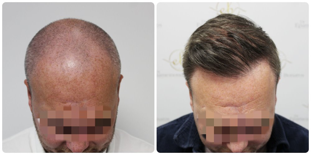 dr-bonaros-hair-transplant-glasgow-result (12) (1).jpg