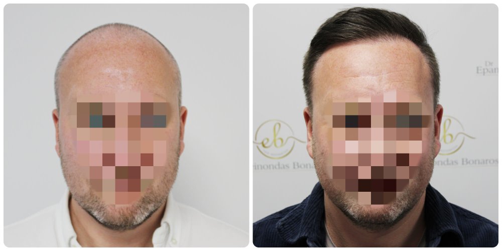 dr-bonaros-hair-transplant-glasgow-result (13) (1).jpg