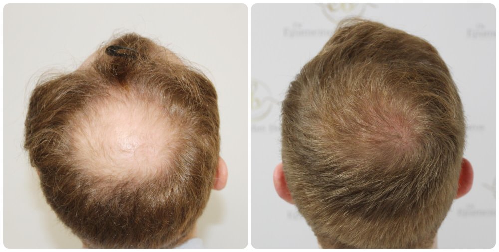 dr-bonaros-hair-transplant-glasgow-result (17)-2.jpg