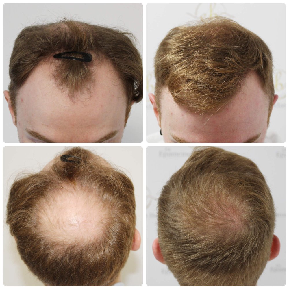 dr-bonaros-hair-transplant-glasgow-result (2).jpg
