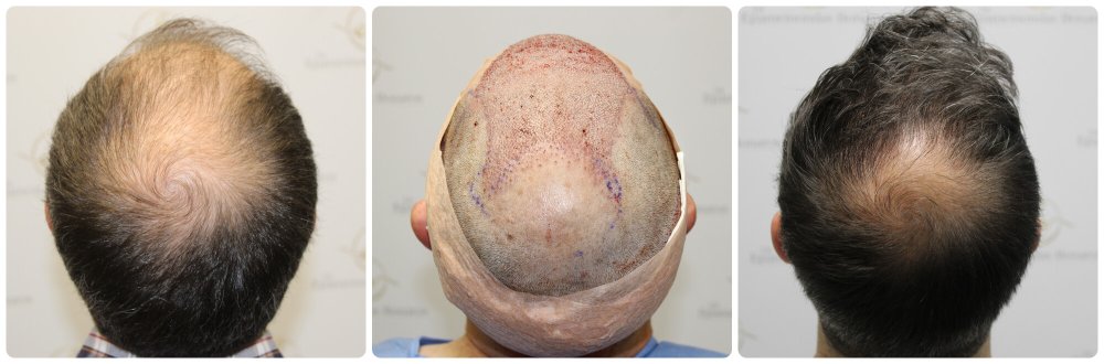 dr-bonaros-hair-transplant-glasgow-result (2).jpg
