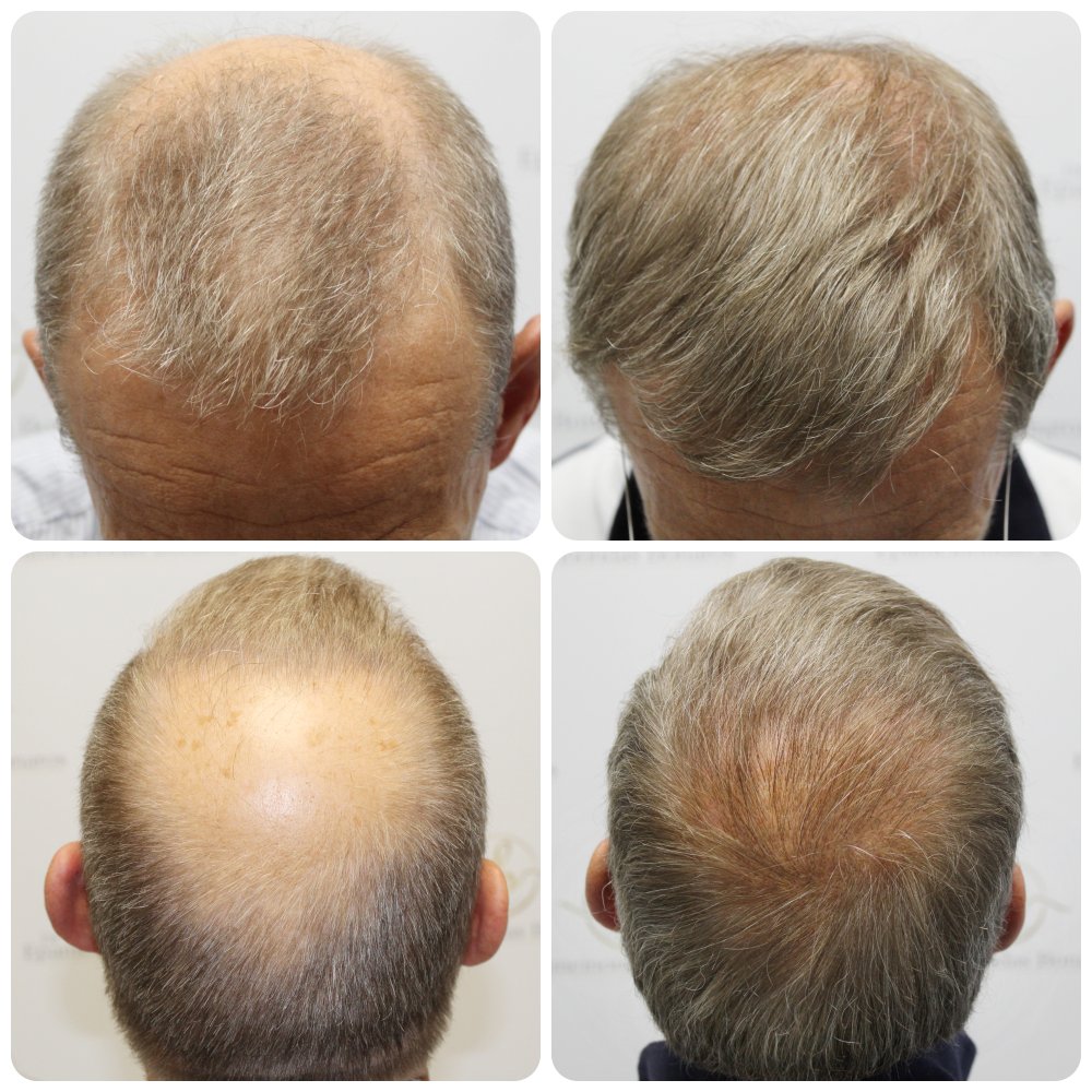 dr-bonaros-hair-transplant-glasgow-result (23).jpg