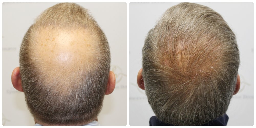 dr-bonaros-hair-transplant-glasgow-result (24).jpg